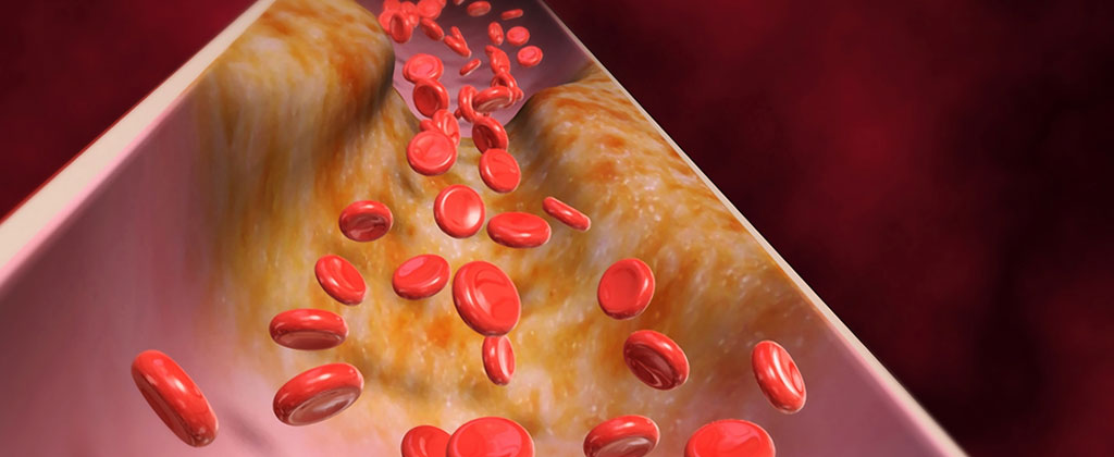 Controlling Cholesterol